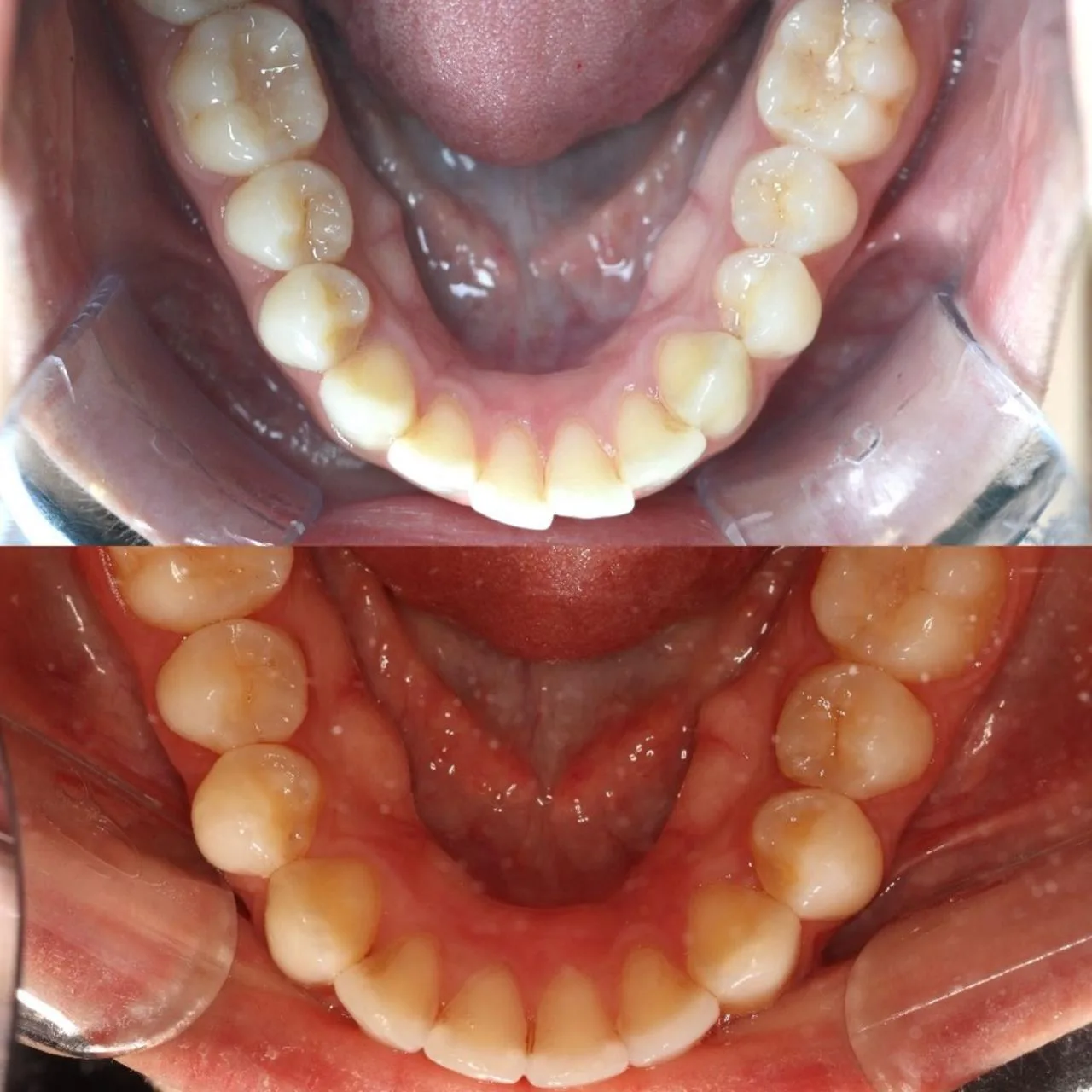 Caso 1 — Antes e depois: alinhamento inferior com Invisalign